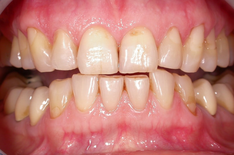 Abradierte, gelbliche Zähne mit vielen Kunststoff-Füllungen und Kronen, die der Patientin nicht gefallen haben